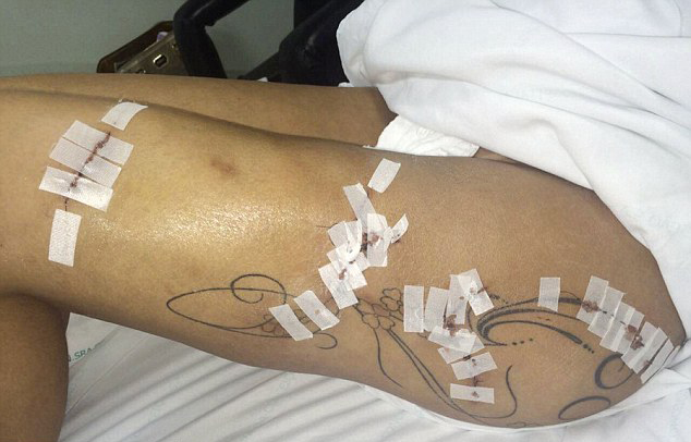 巴西女模臀部整形致感染 紧急手术取出巨臀填