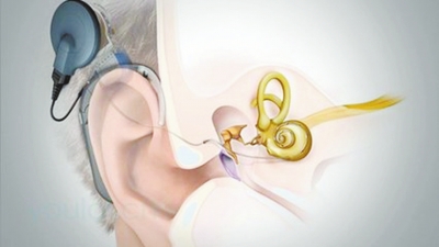 【健康-文字列表】电子耳蜗的冬季保养常识