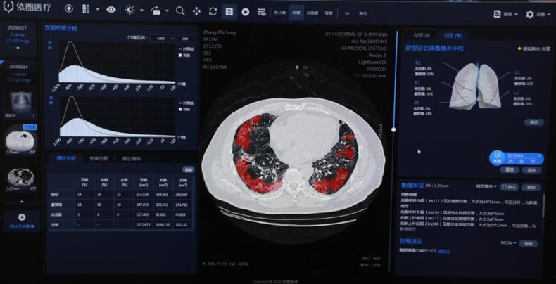 病情评估短至3秒 沈阳市第六人民医院启动新冠病毒肺炎智能评价系统