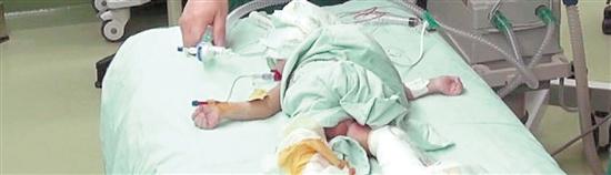 Jiangxi conjoined twin boys, who successfully separated operation used 3D printing (Figure)