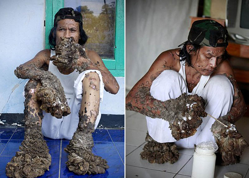 印尼"树人"抱憾去世 至死未能治愈怪病(组图)