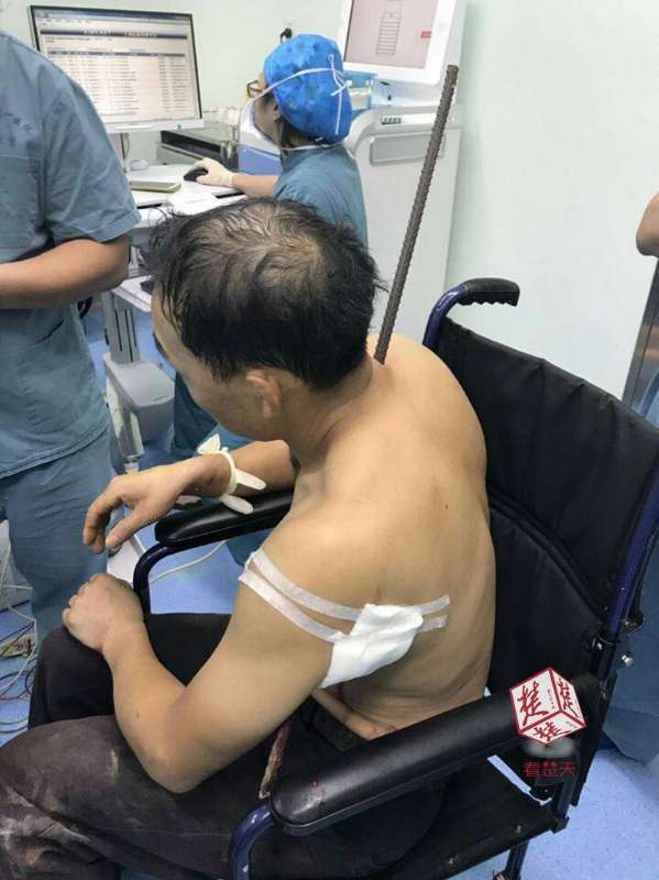 男子高空坠落遭1米多长钢筋穿身而过 7名专家救治