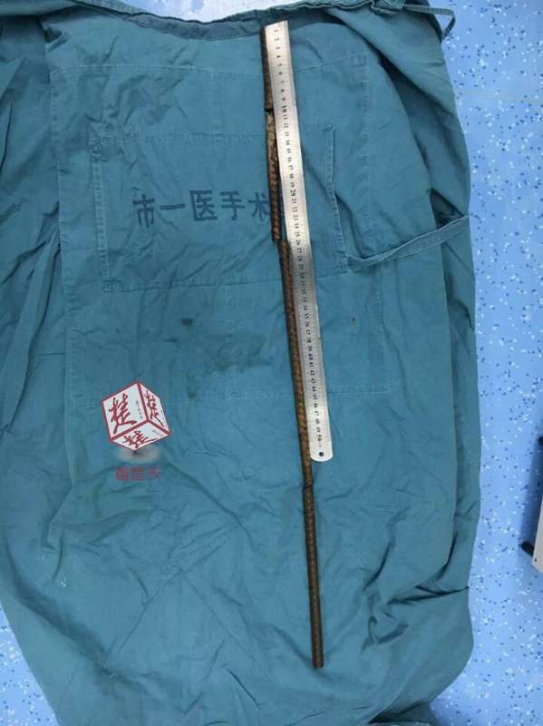 男子高空坠落遭1米多长钢筋穿身而过 7名专家救治