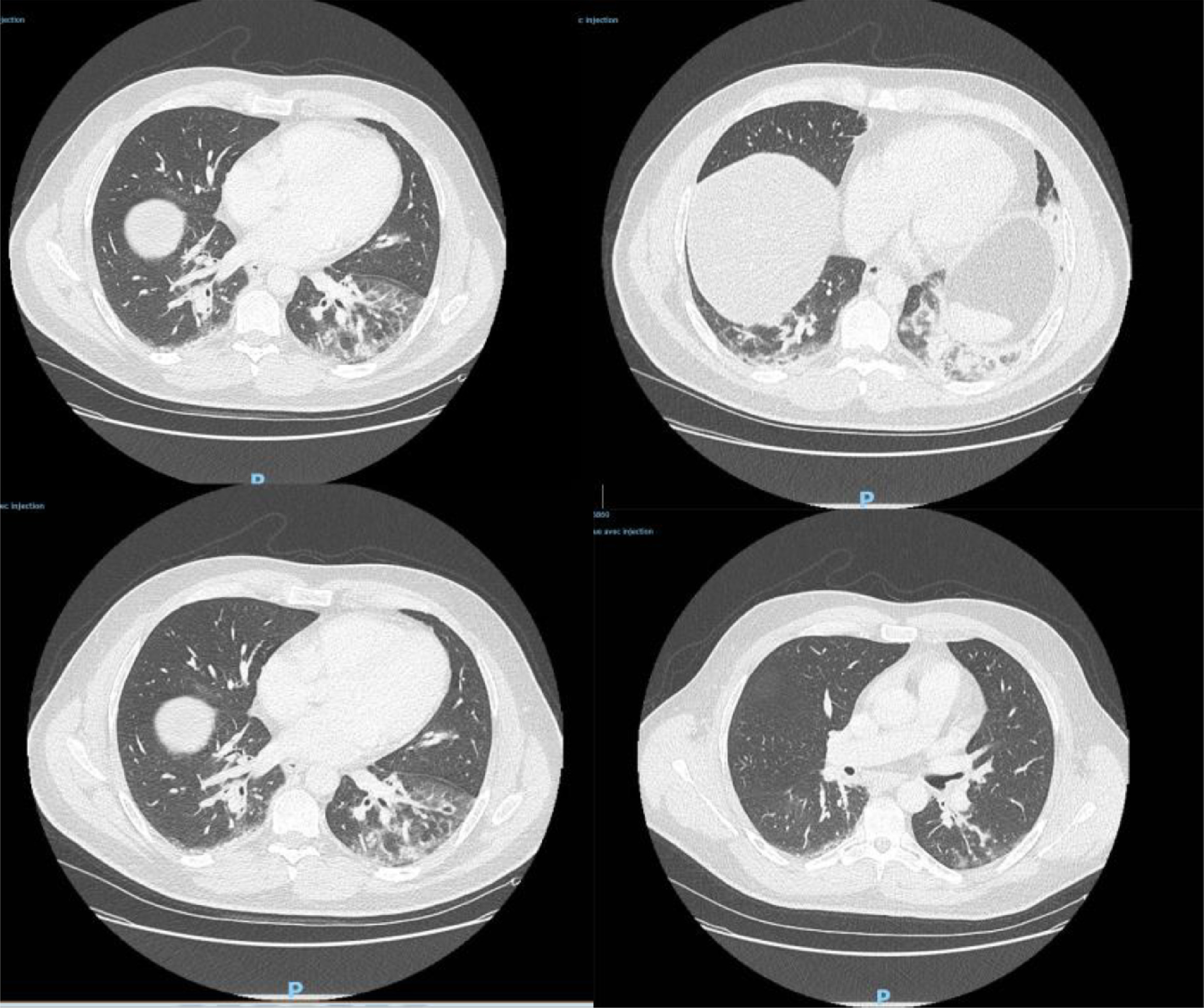 医学论文:新冠病毒去年12月底已在法国传播