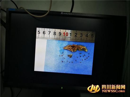 4岁男孩反复咯血 罪魁祸首是鼻子里的狗尾草