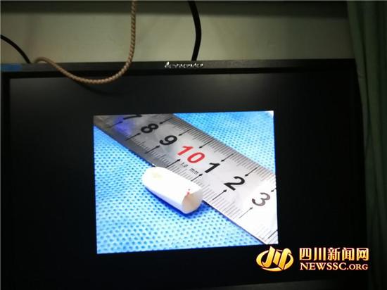 4岁男孩反复咯血 罪魁祸首是鼻子里的狗尾草