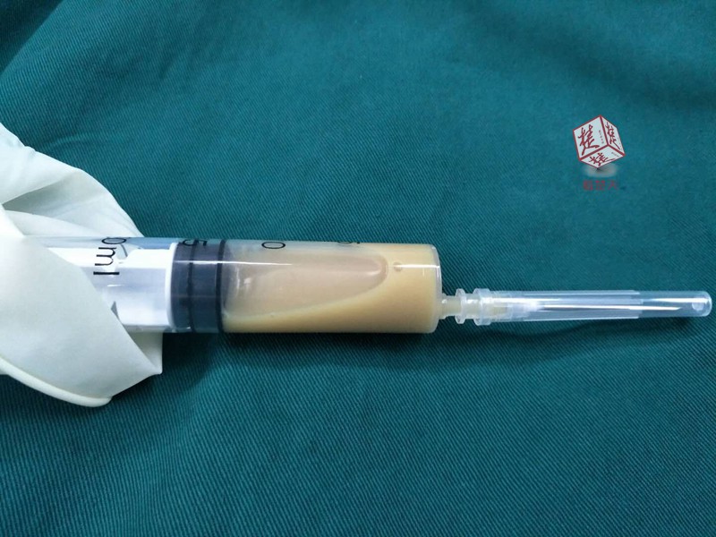 爱心女子收养流浪猫狗意外感染细菌 大脑中长出脓包