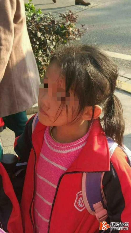 6岁女孩疑遭生母虐打 警方:其母涉虐待罪已被刑拘