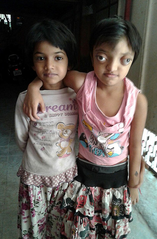 印度女孩患罕见病长”青蛙眼“ 饱受痛苦欺凌(组图)