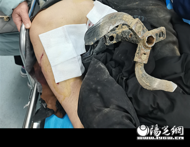 （转载）20厘米齿轮刺入大腿 西安市红会医院紧急救治
