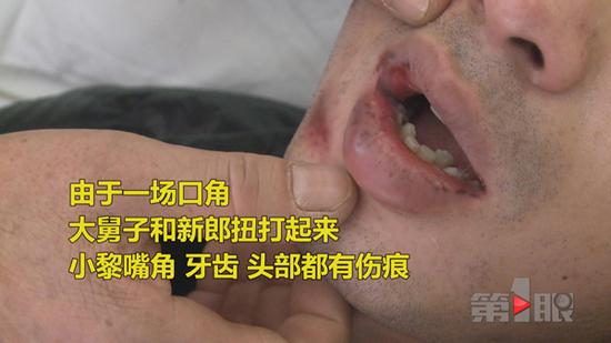 夫妻婚礼彩排时发生口角 结婚前一晚新郎被打住院