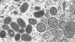 哥伦比亚发现3例猴痘病例