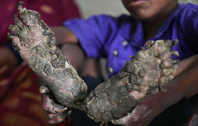 孟加拉国7岁男孩患怪病 手脚长厚皮似树根(组图)