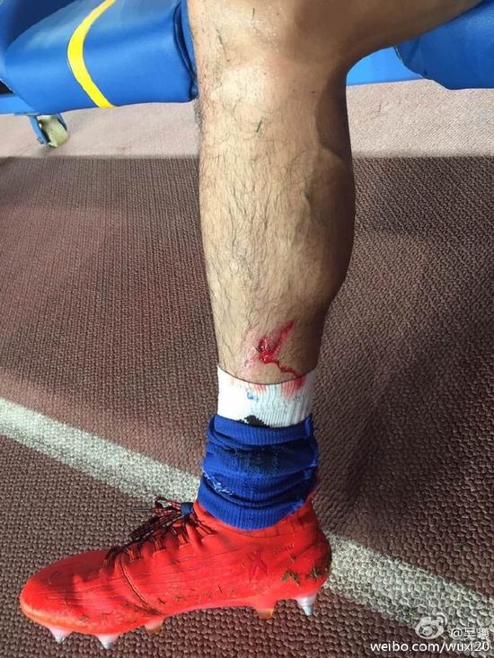 而在赛后,吴曦在个人新浪微网志上发布了自己小腿受伤的照片,可谓十分