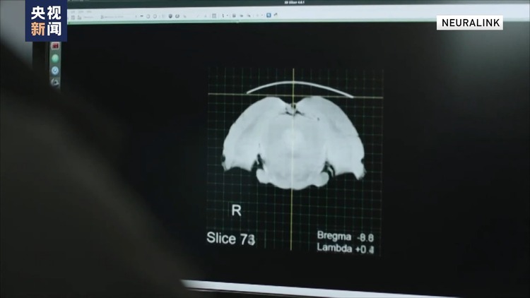 美邦企业家马斯克外示首例脑机接口筑设人体移植完竣
