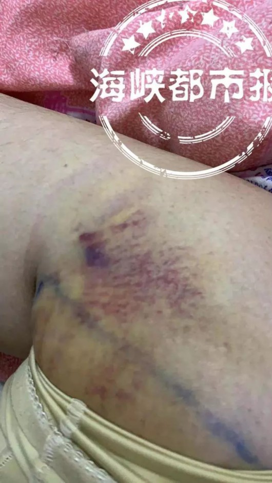 术后半个月小金右腿根部淤青严重