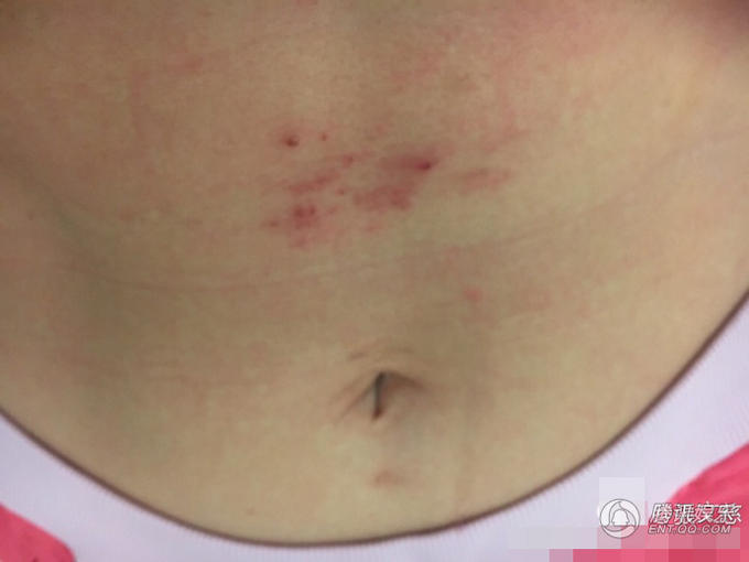 当演员不宜 女星拍古装戏腿部腰部被划伤(组图)