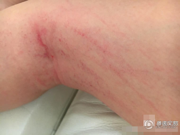 当演员不宜 女星拍古装戏腿部腰部被划伤(组图)