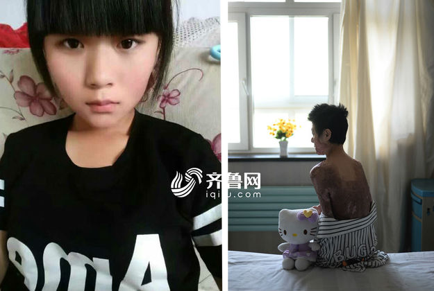 【社会广角(图片+摘要)】【走遍山东-青岛】青岛烧伤美女用直播讲述励志故事鼓励身边人 【社会广角(图片+摘要)】【走遍山东-青岛】青岛烧伤美女用直播讲述励志故事鼓励身边人