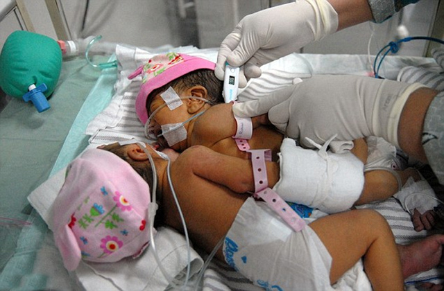 印尼诞下连体女婴 胸部腹部粘连共用一颗心脏