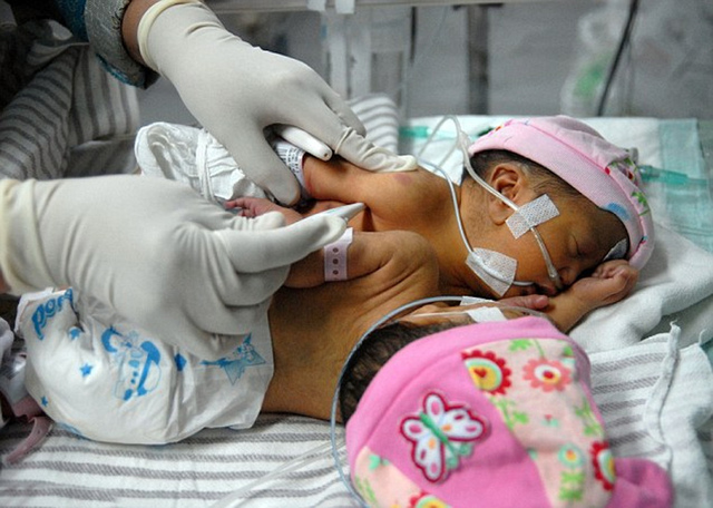 印尼诞下连体女婴 胸部腹部粘连共用一颗心脏