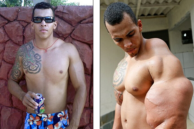 巴西男子为获健美身材注射油和酒精 险致截肢