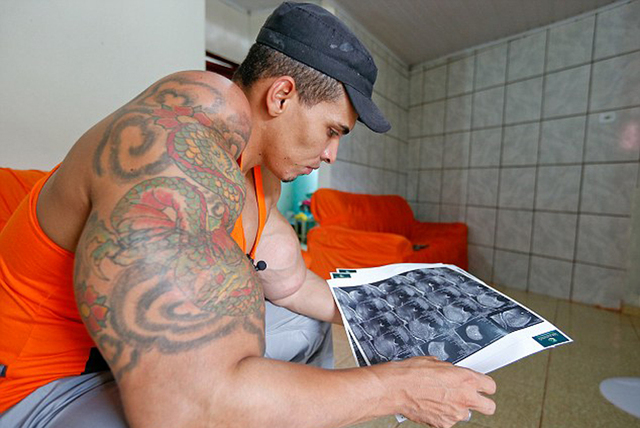 巴西男子为获健美身材注射油和酒精 险致截肢