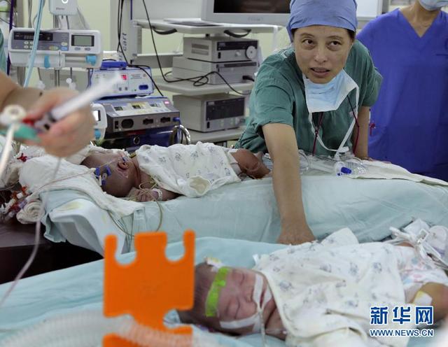上海一对连体女婴被成功分离