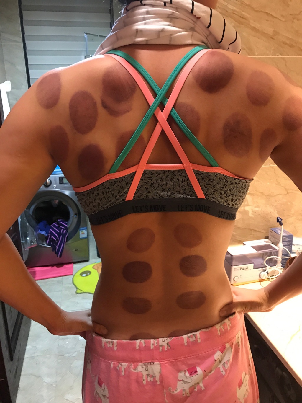 傅园慧扎针灸熏艾草治伤病