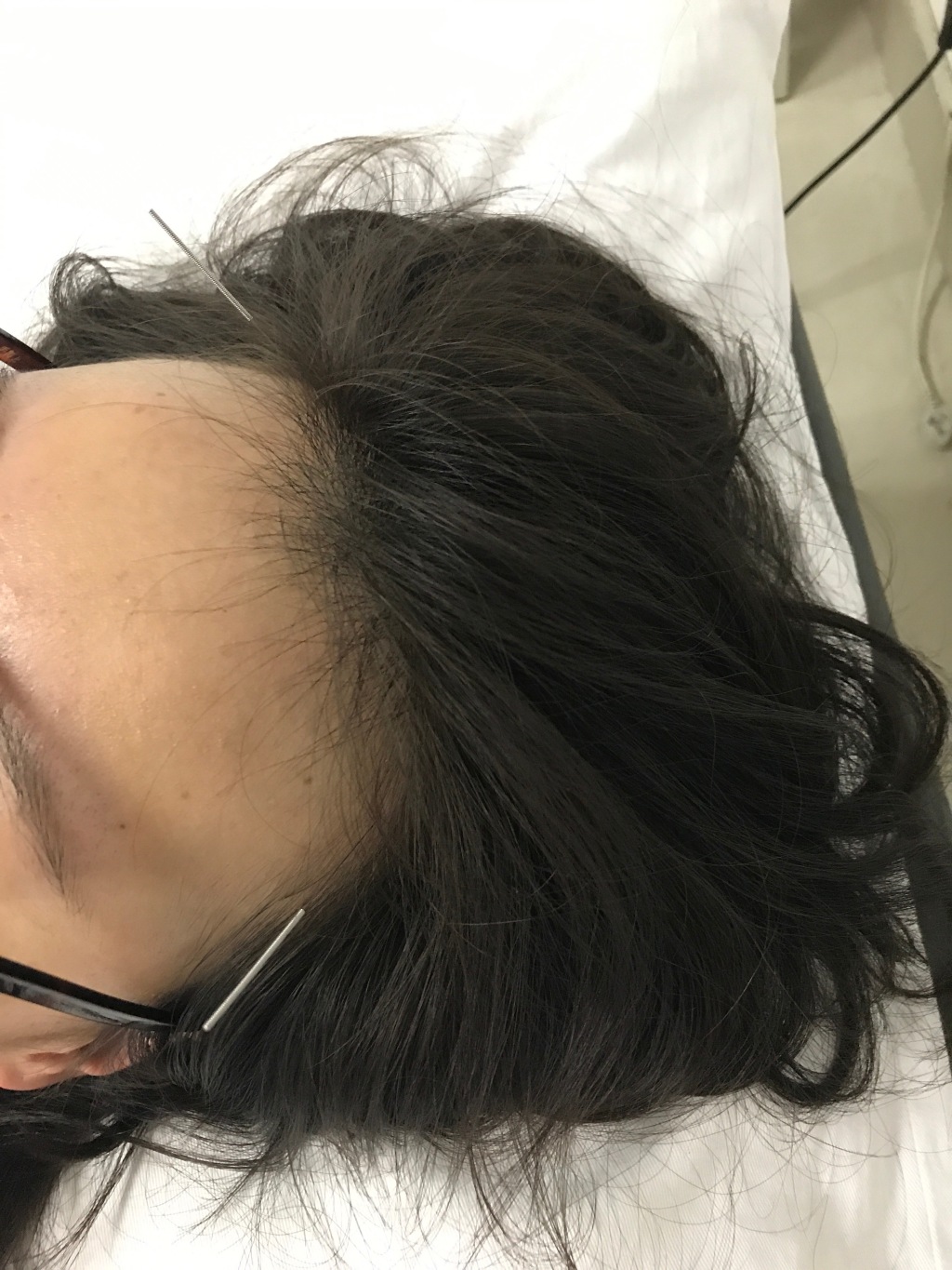 傅园慧扎针灸熏艾草治伤病