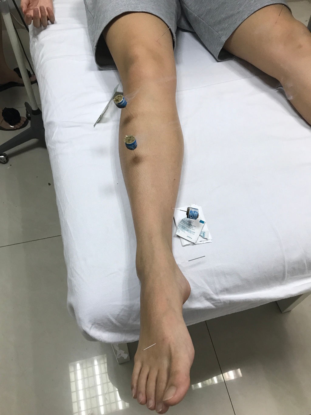 傅园慧扎针灸熏艾草治伤病