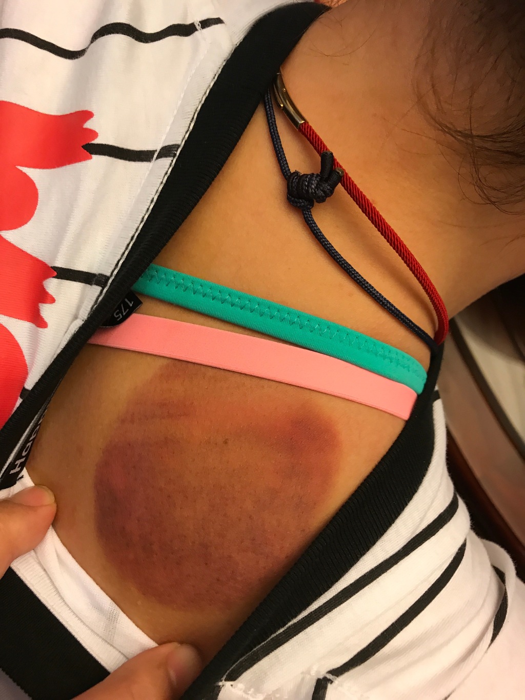 傅园慧扎针灸熏艾草治伤病