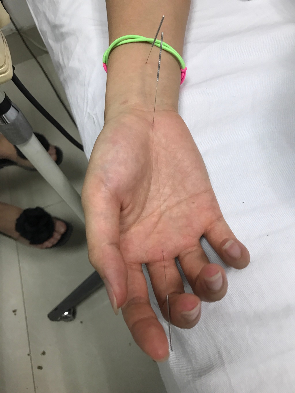 傅园慧扎针灸熏艾草治伤病