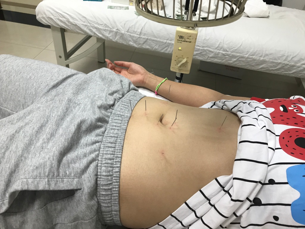 傅园慧扎针灸熏艾草治伤病