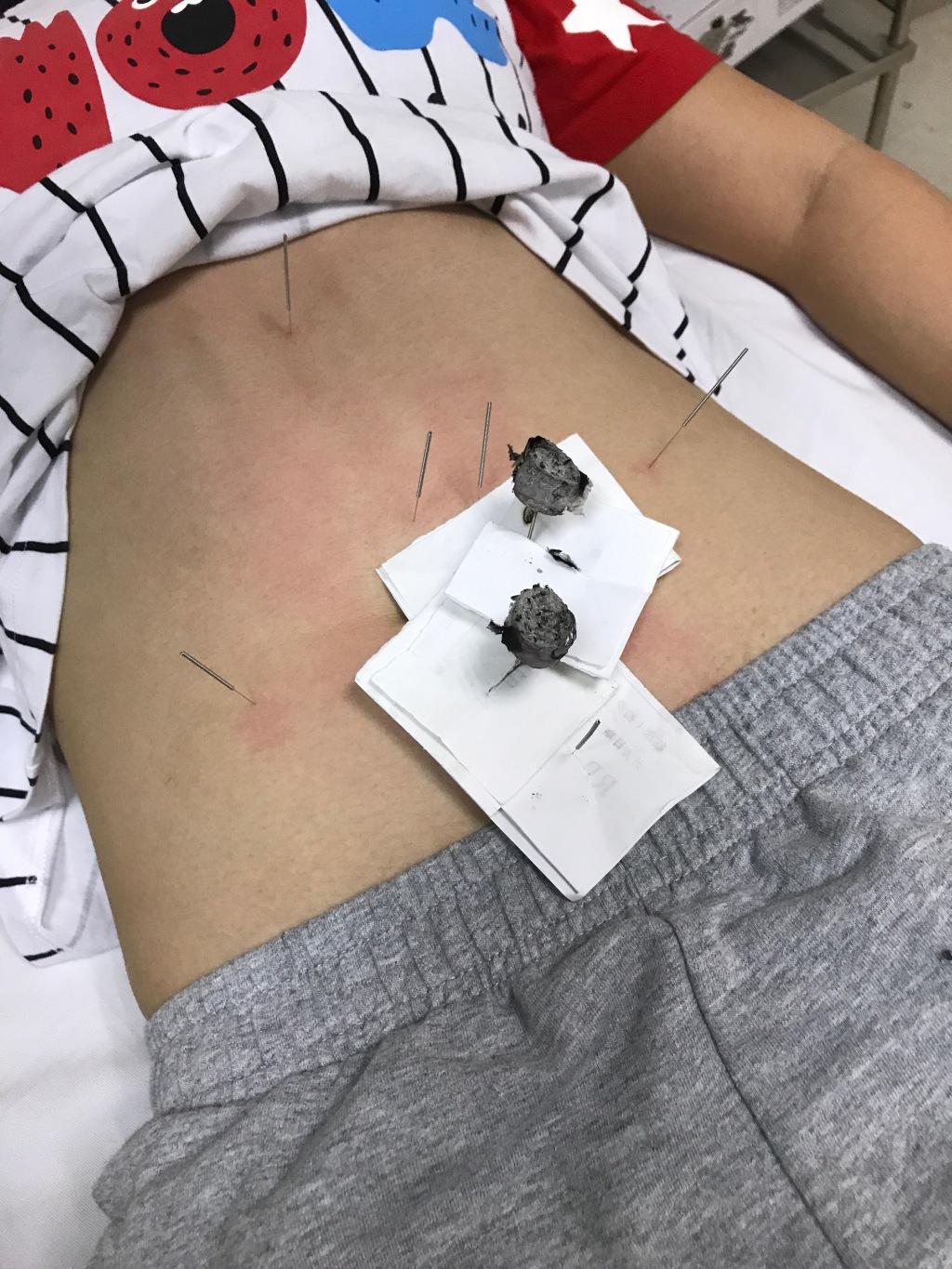 傅园慧扎针灸熏艾草治伤病