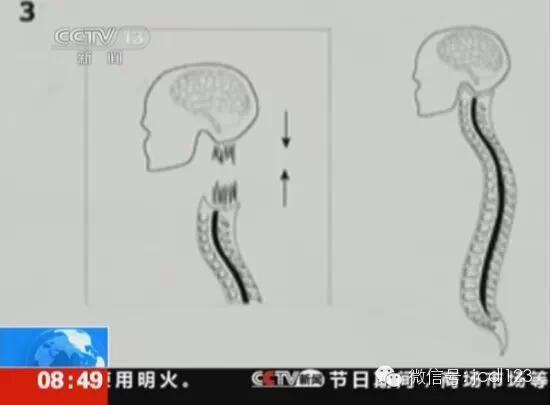 俄男子將接受世界首例頭顱移植手術