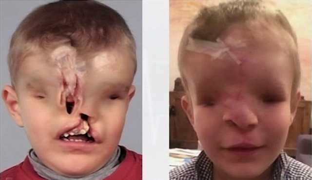 摩洛哥男孩天生沒有鼻子眼睛 赴澳整形獲得新面孔