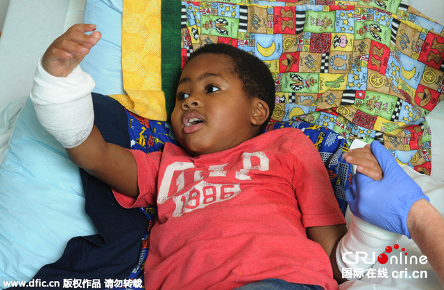 美国一八岁男孩成功移植双手 成为世界首位接受双手移植的儿童