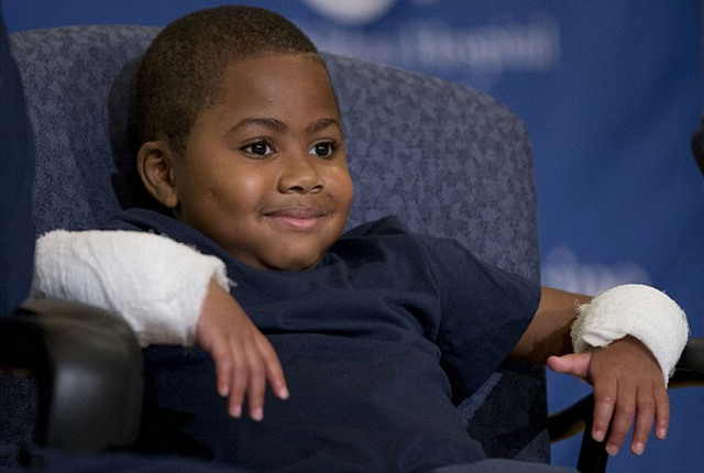 美国一八岁男孩成功移植双手 成为世界首位接受双手移植的儿童