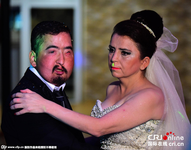 土耳其第六例接受“换脸”手术患者结婚