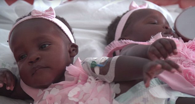 烏干達連臀女嬰在美國成功分離 手術長達16小時