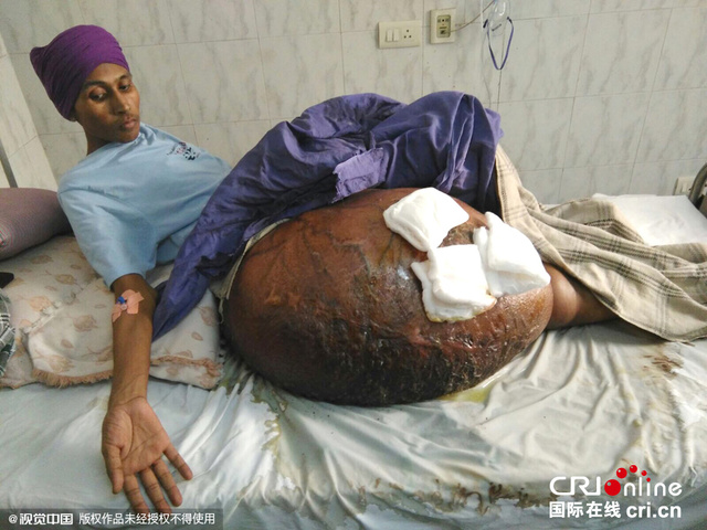 印度男子摘除55公斤重巨型肿瘤 曾卧床3年无法行走