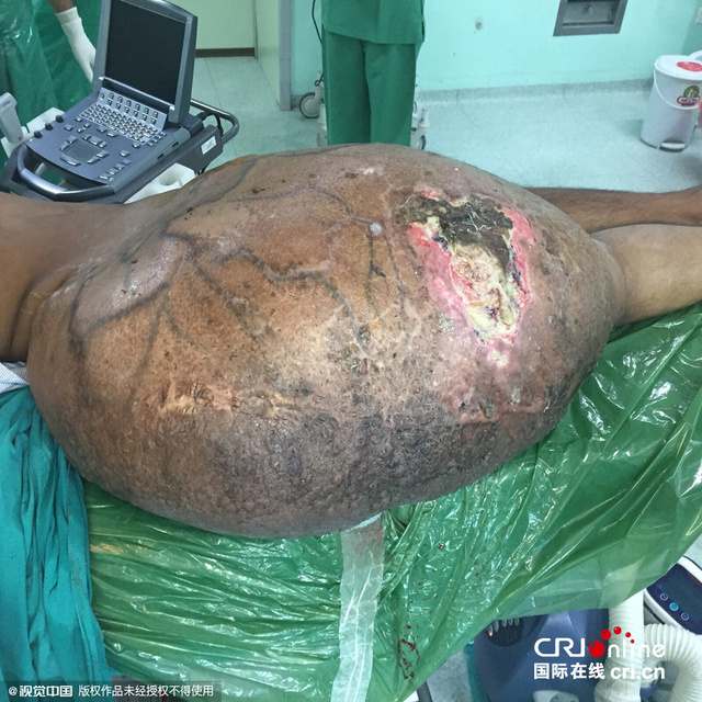 印度男子摘除55公斤重巨型肿瘤 曾卧床3年无法行走