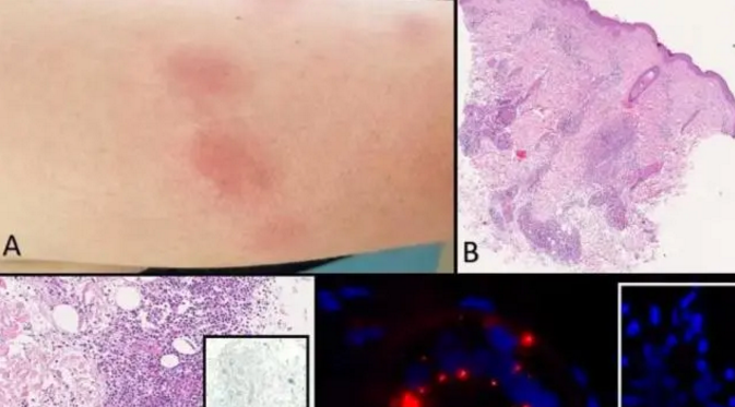 이탈리아 여성 2019년 11월에 코로나19에 감염_fororder_rBABCl_9n6WAGxTvAAAAAAAAAAA430.673x373
