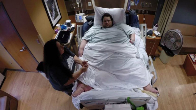 世界最胖男子減肥手術後患疝氣 被迫切除80釐米腸道