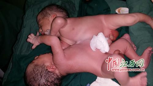 江西18岁孕妇首次分娩诞下连体双胞胎男婴(图)