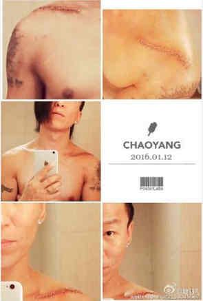 陈羽凡晒锁骨伤 盘点因工受伤的明星(组图)