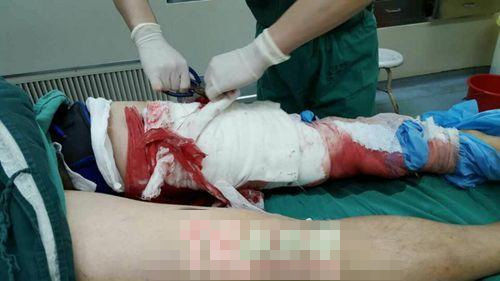 电影长征之路拍摄现场发生爆炸多人受伤一人截肢