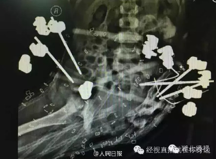 武汉4岁女孩下半身被车碾碎 医生发帖引30万捐款