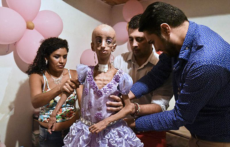 哥伦比亚女孩患早衰症15岁的年纪90岁的身体组图